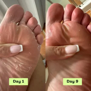 NEGUSY™ Tea Tree Athlete's Foot Defense Soap