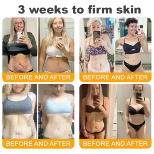 BeeVenom Treatment Cream: Targets Wrinkles, Fine Lines, Sagging, Stretch Marks, Dark Spots, Firming, Lifting, and More