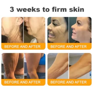 BeeVenom Treatment Cream: Targets Wrinkles, Fine Lines, Sagging, Stretch Marks, Dark Spots, Firming, Lifting, and More