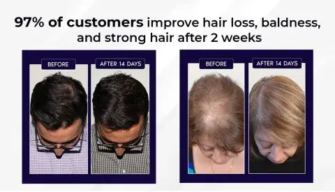 HZA™ Natural Hair Regrowth Spray image HZA™ Natural Hair Regrowth Spray