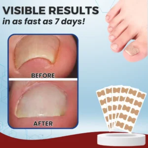 AEXZR® Paronychia Correcting Patch