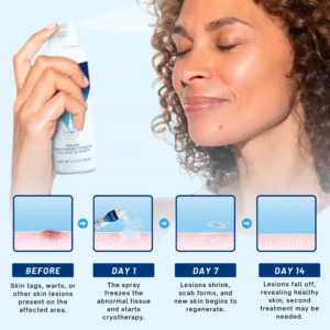 Femica® TagRecede Cryo Treatment Spray