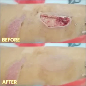 LIMETOW® Bedsore Cream