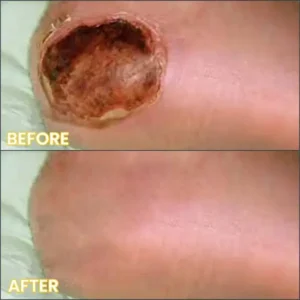 LIMETOW® Bedsore Cream