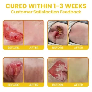 LIMETOW® Bedsore Cream