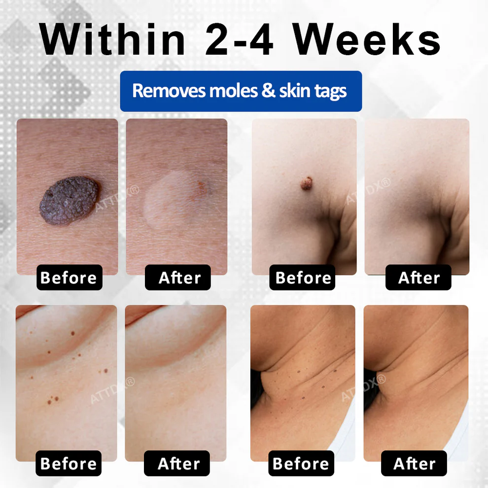 RICPIND® DermaLite Mole and Wart Removal Laser Pen image RICPIND® DermaLite Mole and Wart Removal Laser Pen