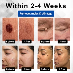 RICPIND® DermaLite Mole and Wart Removal Laser Pen image RICPIND® DermaLite Mole and Wart Removal Laser Pen