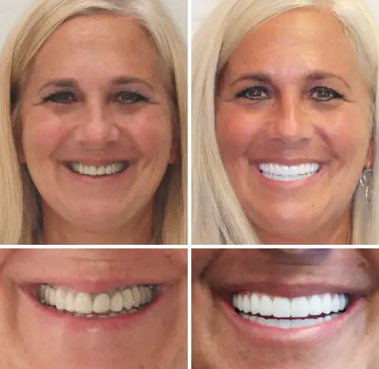 HZA™ Advanced Customized Full Denture Set