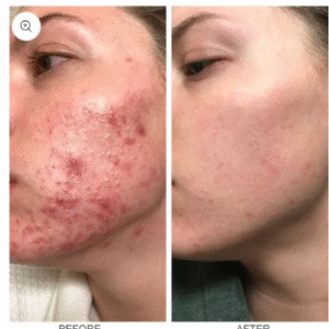 LIMETOW™ herbal acne removal cream image LIMETOW™ herbal acne removal cream