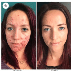 LIMETOW™ herbal acne removal cream image LIMETOW™ herbal acne removal cream