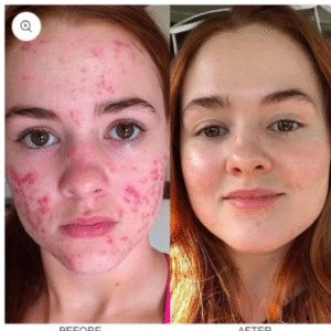 LIMETOW™ herbal acne removal cream image LIMETOW™ herbal acne removal cream