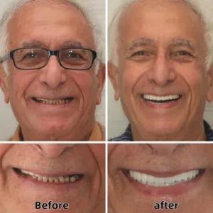 ROSOPL™ Custom Functional Denture Kits image ROLOPL™ Custom Functional Denture Kits