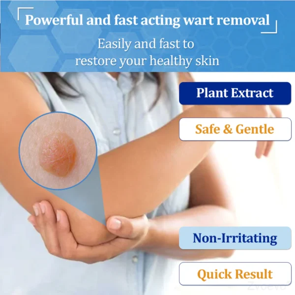 Zvoevo® BeeDerm RX Cream, Painless, Targeted Treatment for Warts