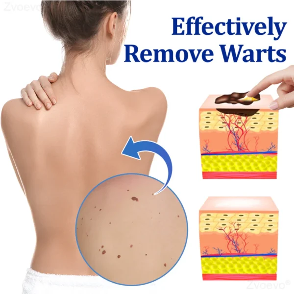 Zvoevo® BeeDerm RX Cream, Painless, Targeted Treatment for Warts - Image 19