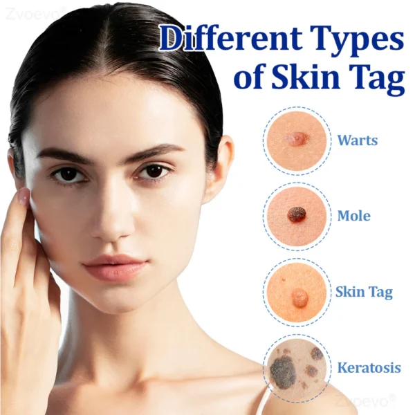 Zvoevo® BeeDerm RX Cream, Painless, Targeted Treatment for Warts - Image 18