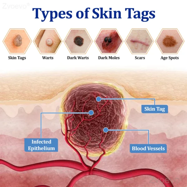 Zvoevo® BeeDerm RX Cream, Painless, Targeted Treatment for Warts - Image 14