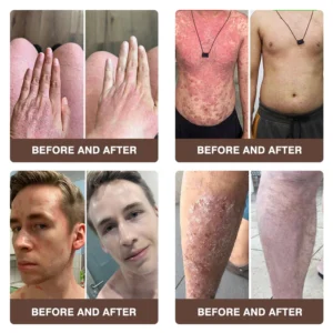 Zvoevo® Psoriasis & Eczema Relief Cream