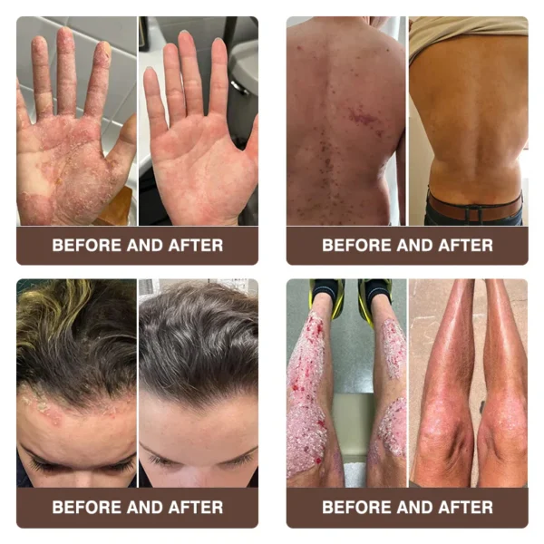 Zvoevo® Psoriasis & Eczema Relief Cream