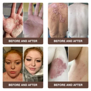 Zvoevo® Psoriasis & Eczema Relief Cream
