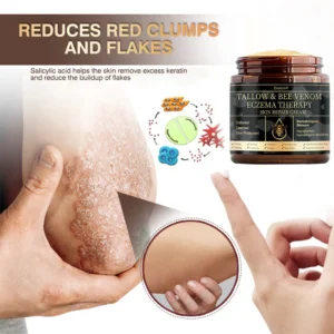 Zvoevo® Psoriasis & Eczema Relief Cream