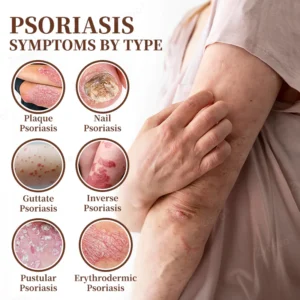 Zvoevo® Psoriasis & Eczema Relief Cream