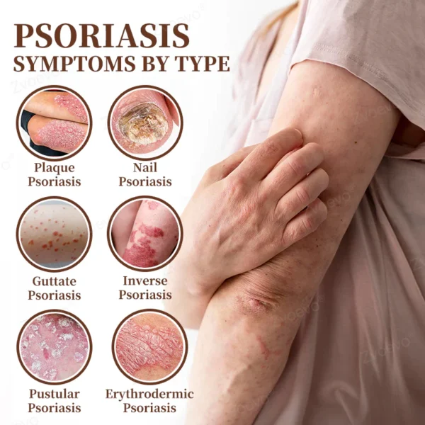 Zvoevo® Psoriasis & Eczema Relief Cream