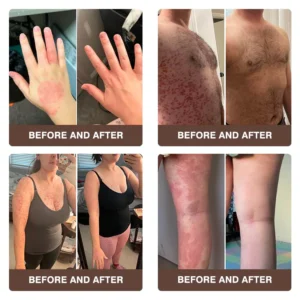 Zvoevo® Psoriasis & Eczema Relief Cream