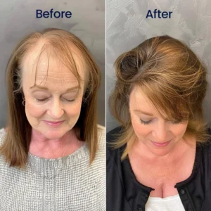 Biancat® Maximum Strength 5% Minoxidil Fast-Action Hair Growth Serum image Biancat® Maximum Strength 5% Minoxidil Fast-Action Hair Growth Serum