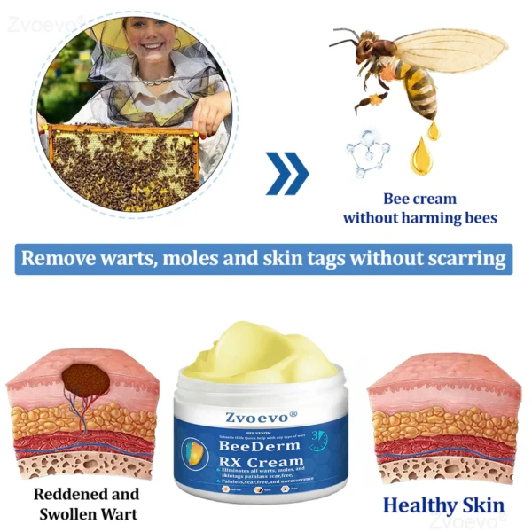 Zvoevo® BeeDerm RX Cream, Painless, Targeted Treatment for Warts - Image 10