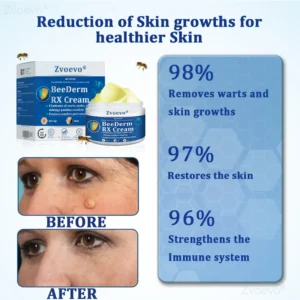 Zvoevo® BeeDerm RX Cream, Painless, Targeted Treatment for Warts