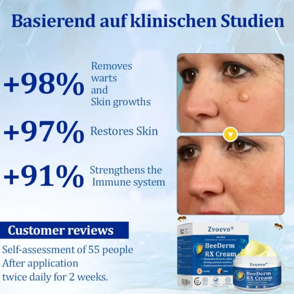Zvoevo® BeeDerm RX Cream, Painless, Targeted Treatment for Warts - Image 12