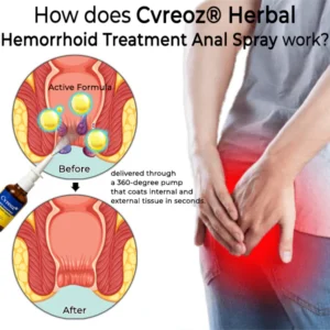Cvreoz® Herbal Hemorrhoid Treatment Anal Spray Pro image Cvreoz® Herbal Hemorrhoid Treatment Anal Spray Pro