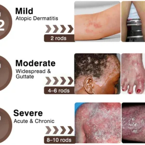 Zvoevo® Psoriasis & Eczema Relief Cream
