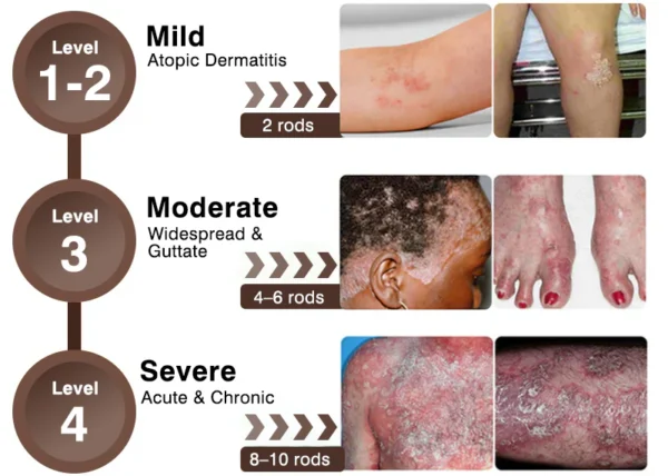 Zvoevo® Psoriasis & Eczema Relief Cream