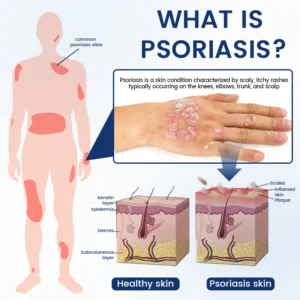 Timilk® PsoriCure Magnesium Herbal Spray image Timilk® PsoriCure Magnesium Herbal Spray