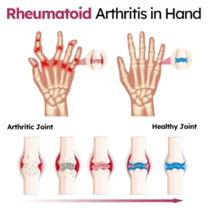 Slimoly™ Advanced Joint & Bone Renewal Cream