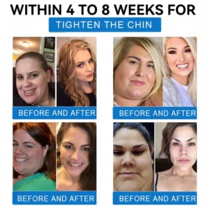 LBMLBM® SMGT-GLP-1 Tirzepatide & Collagen Nano Microneedle Weight Loss Patch image LBMLBM® SMGT-GLP-1 Tirzepatide & Collagen Nano Microneedle Weight Loss Patch