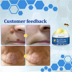 Zvoevo® BeeDerm RX Cream, Painless, Targeted Treatment for Warts