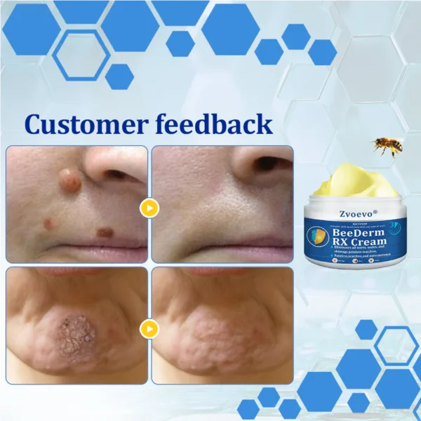 Zvoevo® BeeDerm RX Cream, Painless, Targeted Treatment for Warts