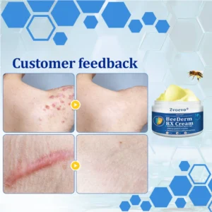 Zvoevo® BeeDerm RX Cream, Painless, Targeted Treatment for Warts