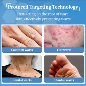 Zvoevo® BeeDerm RX Cream, Painless, Targeted Treatment for Warts