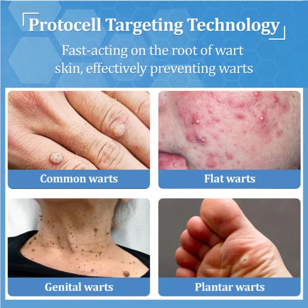Zvoevo® BeeDerm RX Cream, Painless, Targeted Treatment for Warts