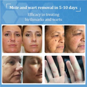Zvoevo® BeeDerm RX Cream, Painless, Targeted Treatment for Warts