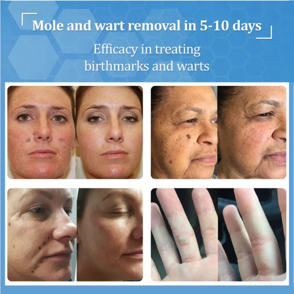 Zvoevo® BeeDerm RX Cream, Painless, Targeted Treatment for Warts