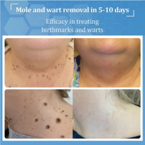 Zvoevo® BeeDerm RX Cream, Painless, Targeted Treatment for Warts