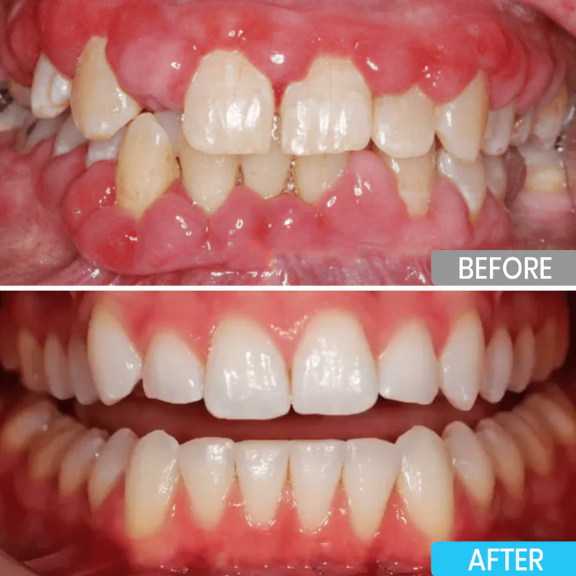 Lyyeto® Focussmile bee venom treatment powder for oral use image Lyyeto® Focussmile bee venom treatment powder for oral use