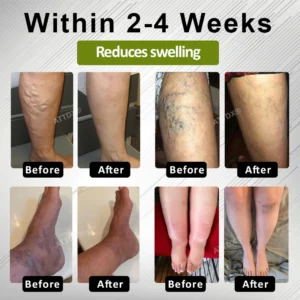 ATTDX® EdemaFree Flow Drain Massage Cream