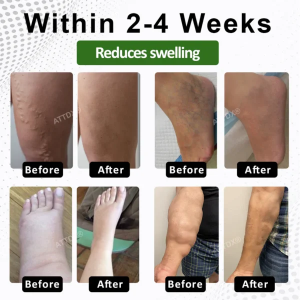 ATTDX® SwellSoothe Lymphatic Cream