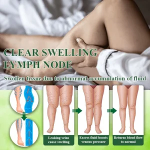 Oveallgo® VeinoRoll Therapy Edema Comfort Cream image Oveallgo® VeinoRoll Therapy Edema Comfort Cream