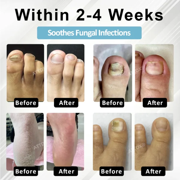 ATTDX® MycoStop Nail Recovery Serum Pen - Image 3